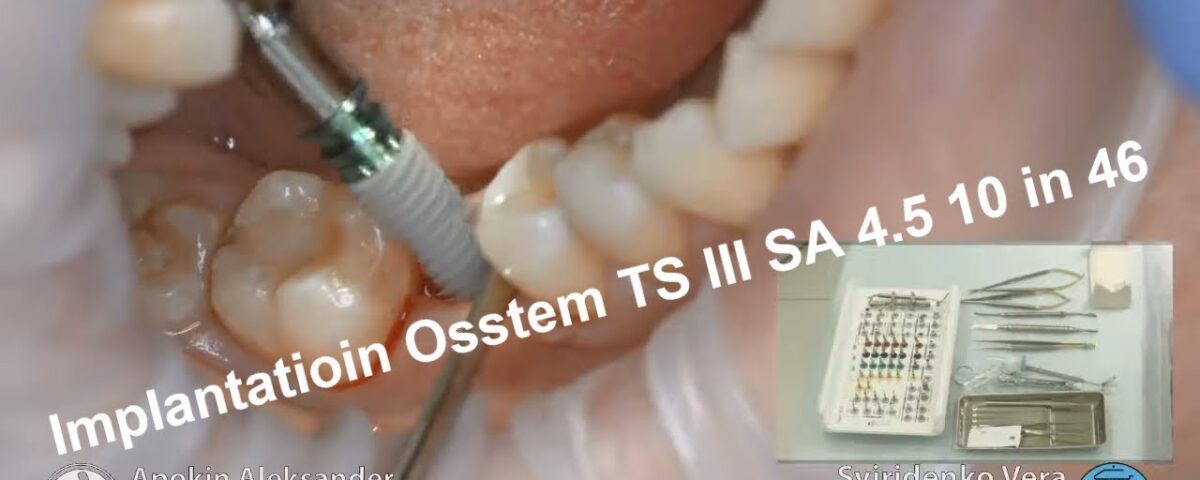 Implantatioin-Osstem-TS-III-SA-in-plase-of-tooth-46-FHD-multistream