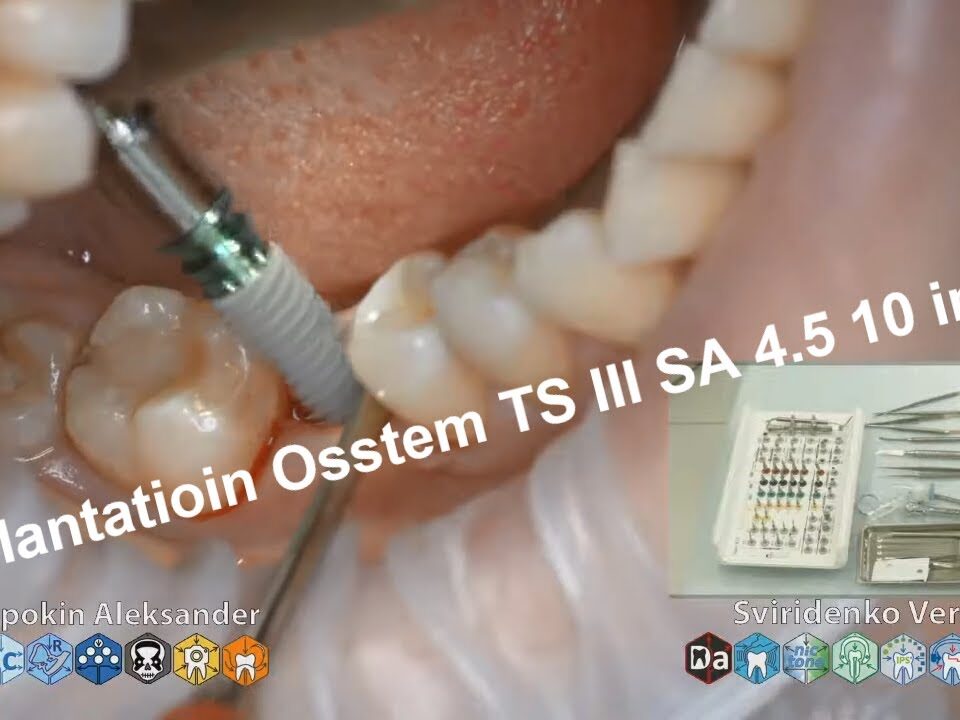 Implantatioin-Osstem-TS-III-SA-in-plase-of-tooth-46-FHD-multistream