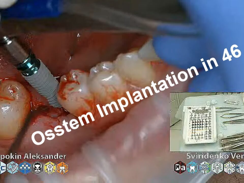 Implantation-Osstem-TS-III-SA-4.5-11.5-in-plase-of-tooth-46-multistream