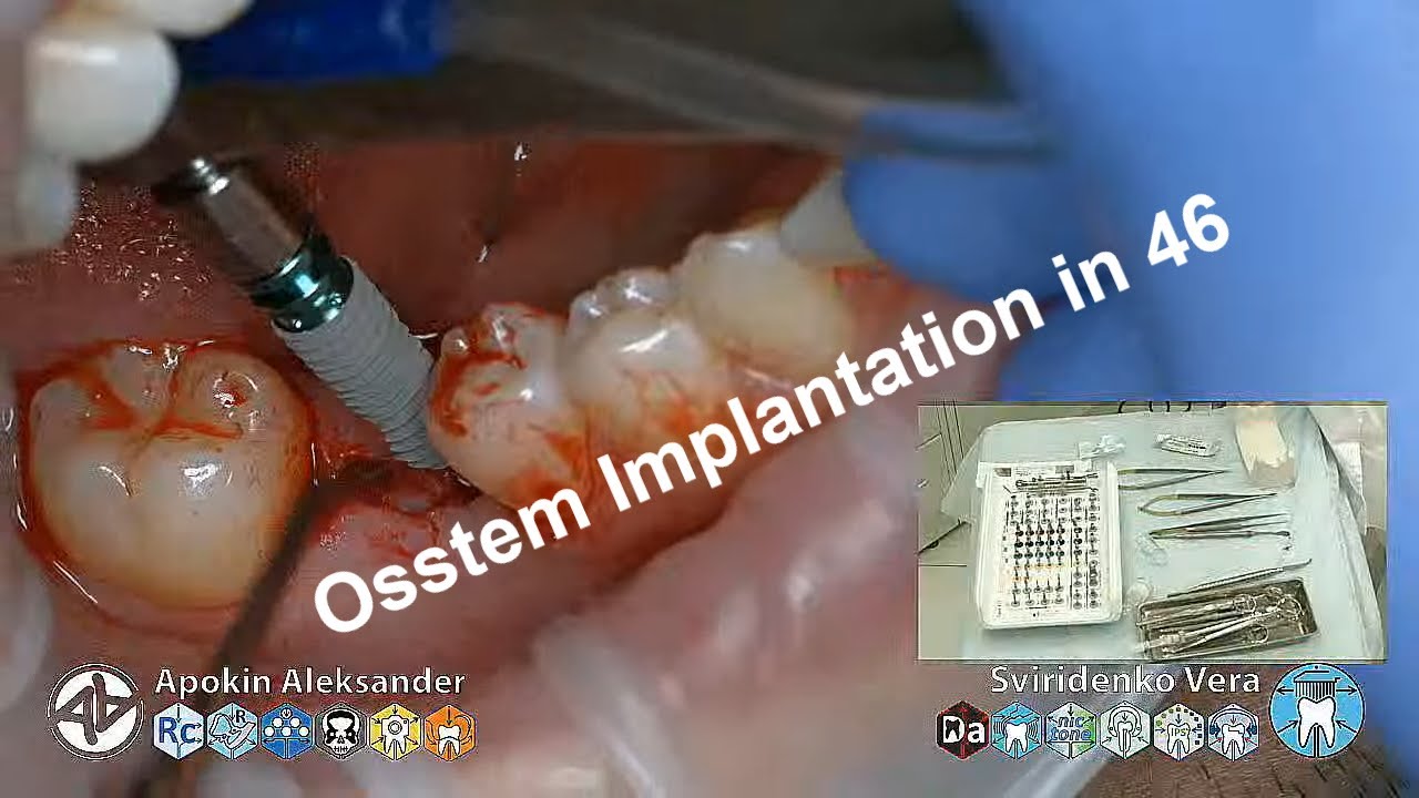 Implantation-Osstem-TS-III-SA-4.5-11.5-in-plase-of-tooth-46-multistream